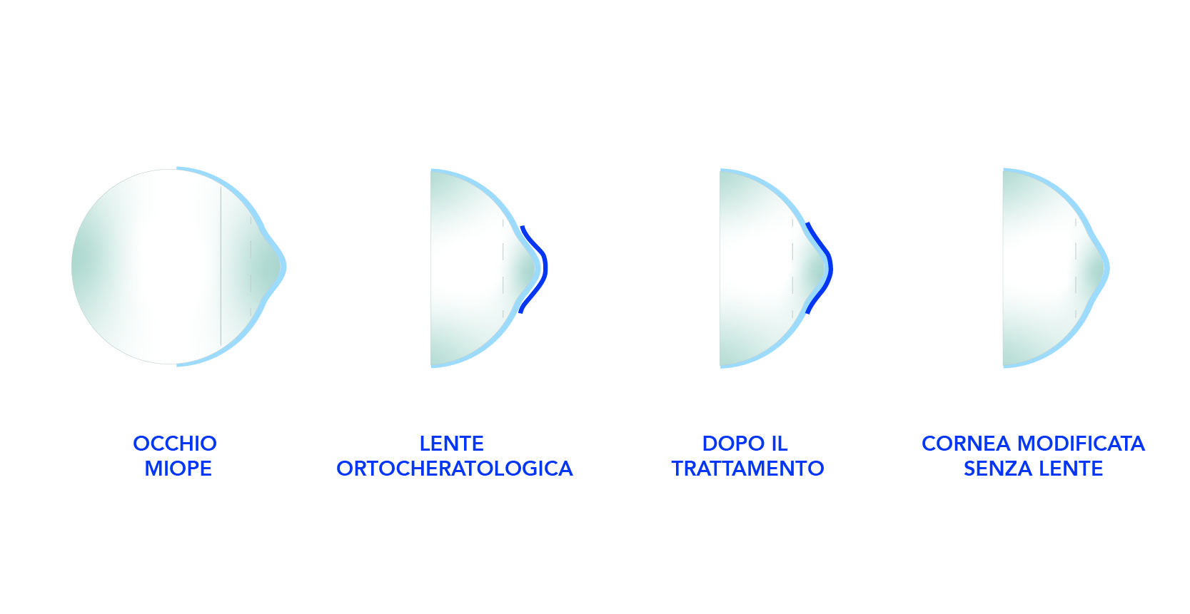 Ortocheratologia Ottica Centro
